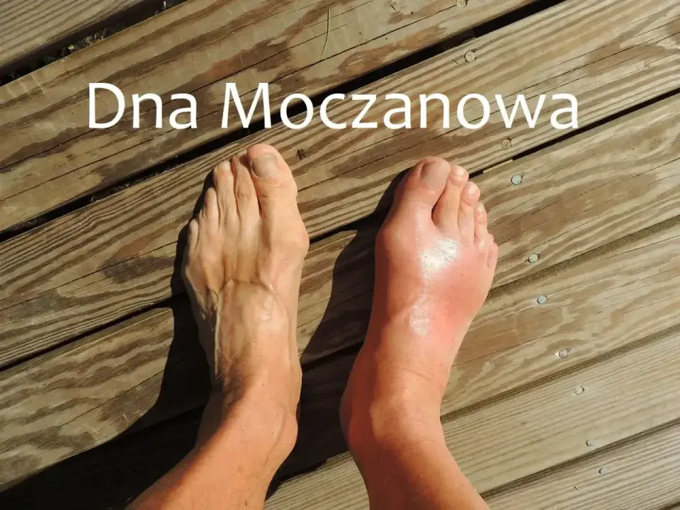 Artretyzm, czyli dna moczanowa - jak rozpoznać i opanować napad?